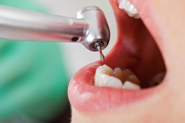 Best Emergency Root Canal Treatment in Parker, AZ